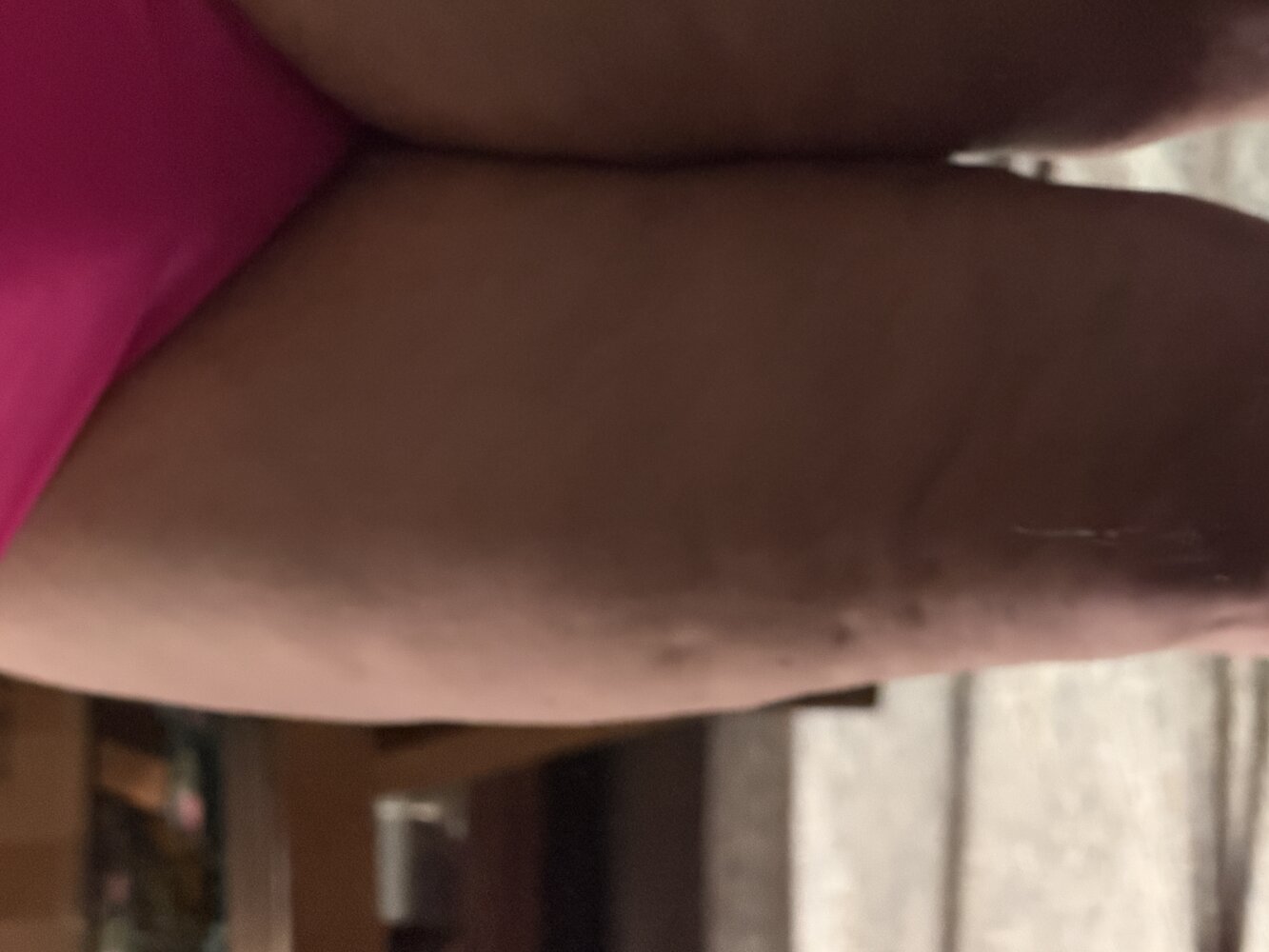 Same leg after lymphatic drainage and compression therapy, swelling and nodularity reduced